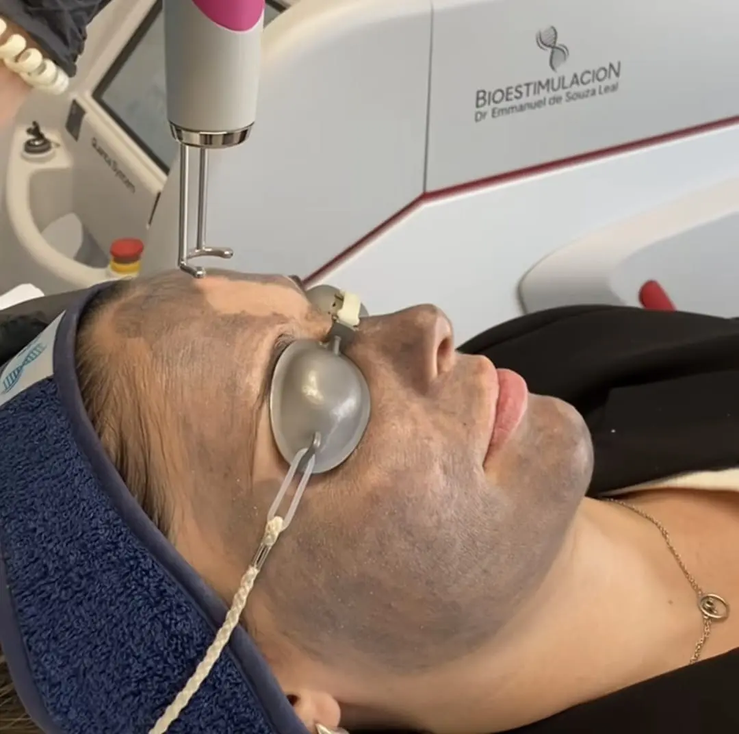 Cuidado de la piel en Montevideo – Bioestimulación